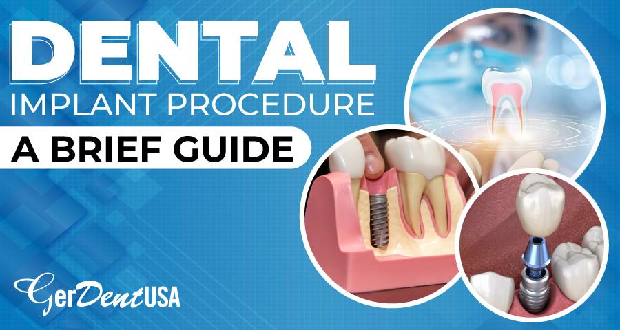 Dental Implant Procedure: A Brief Guide