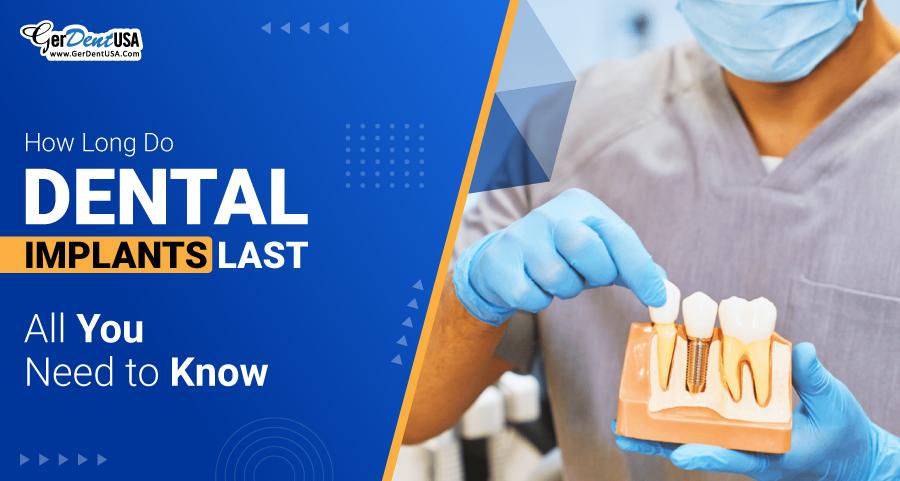How Long Do Dental Implants Last: All You Need to Know