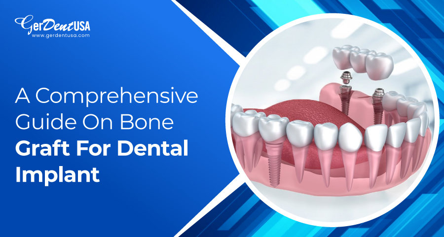 A Comprehensive Guide On Bone Graft For Dental Implant