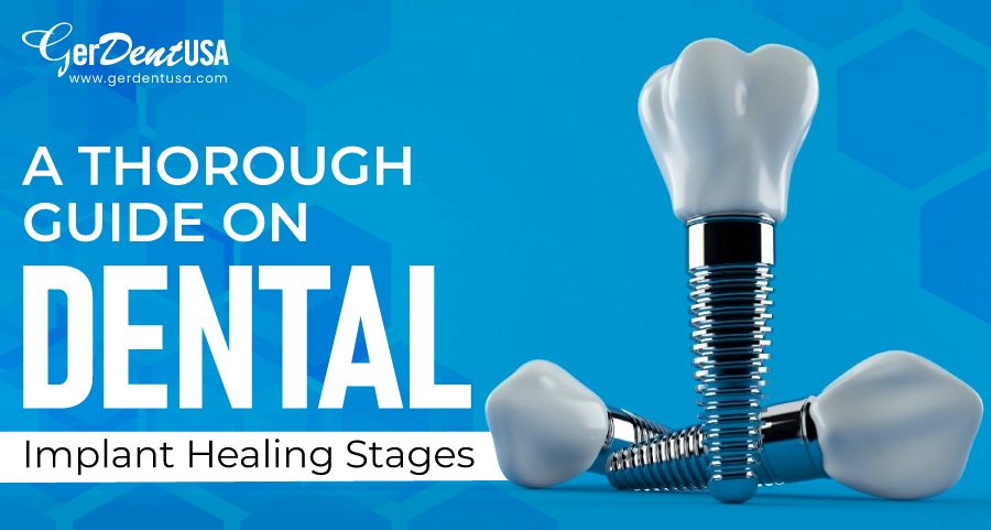 A Thorough Guide on Dental Implant Healing Stages