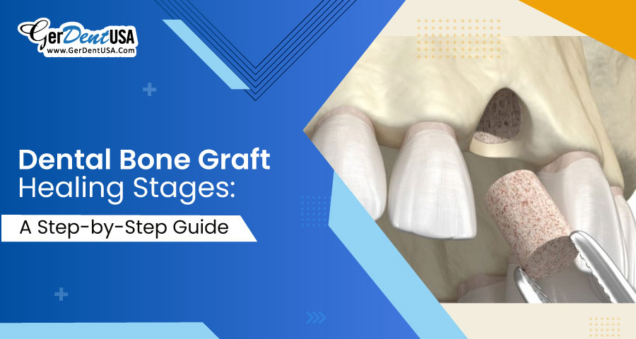 Dental Bone Graft Healing Stages: A Step-by-Step Guide