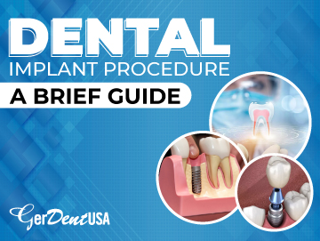 Dental Implant Procedure: A Brief Guide