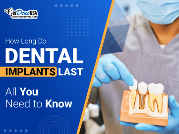 How Long Do Dental Implants Last: All You Need to Know