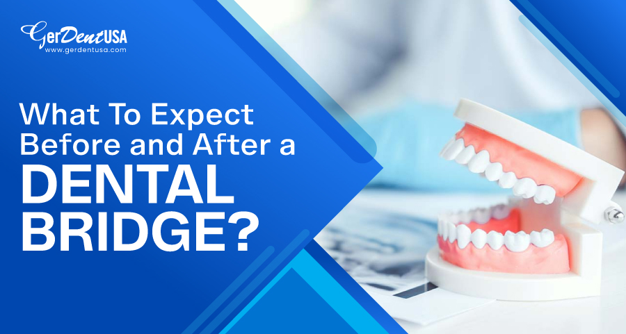 What To Expect Before and After a Dental Bridge?