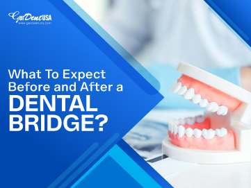 What To Expect Before and After a Dental Bridge?